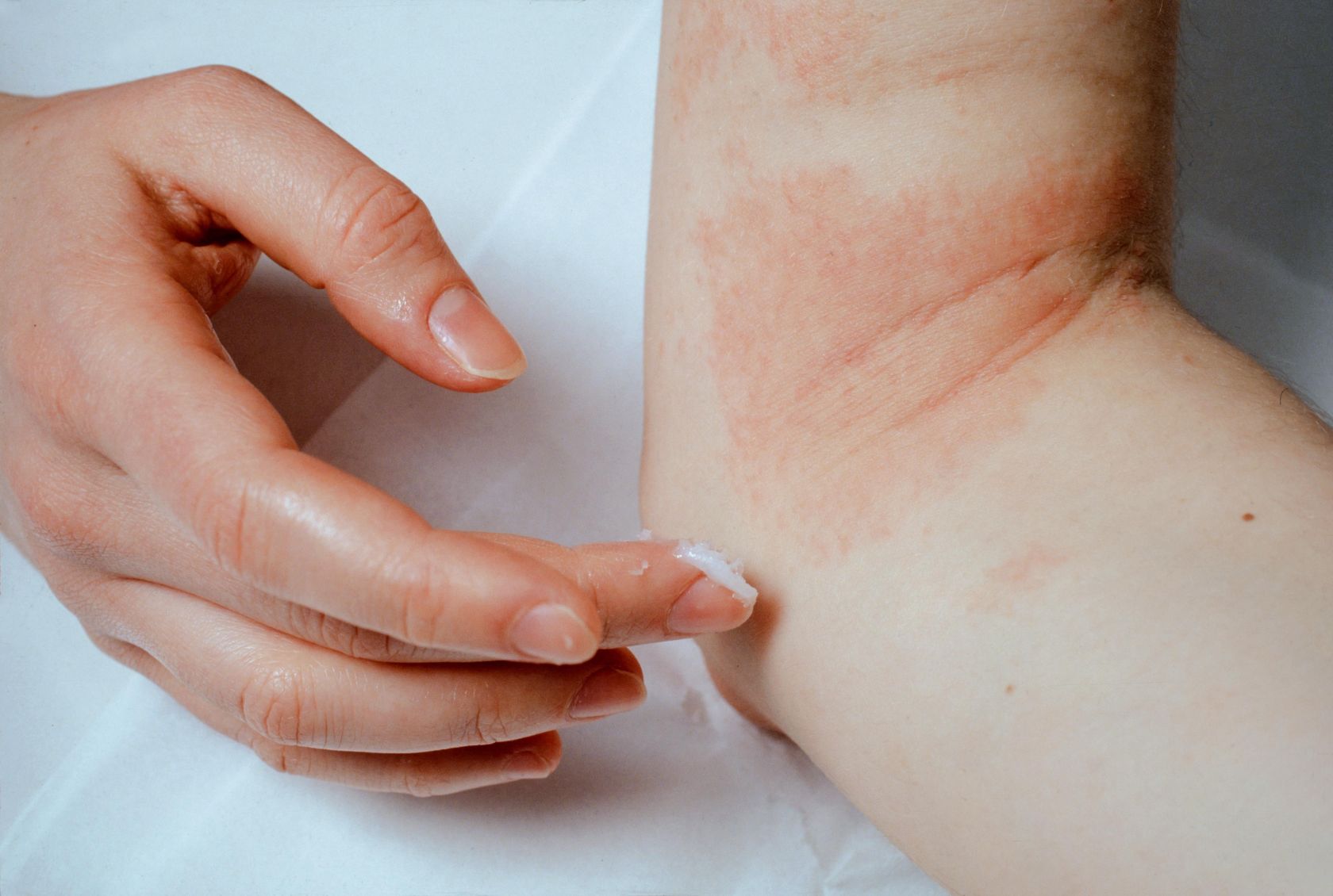 Best psoriasis-friendly skincare routine